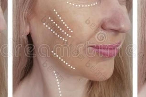 女人面容皱纹在之前后的影响吸水吸水trehalase海藻糖酶