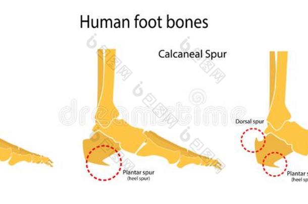 人脚骨骼.脚底的和背的马刺跟骨马刺.图解