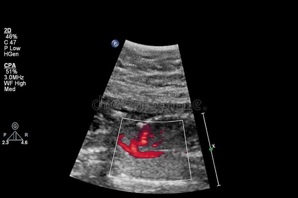 超声<strong>检查</strong>关于指已提到的人<strong>胎儿</strong>的心
