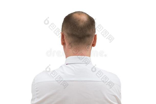 人秃头症或头发损失-成熟的人秃头的上端.背关于秃头的i