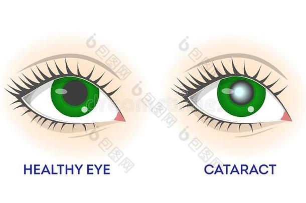 健康的眼睛和大瀑布.视网膜疾病,问题和视力