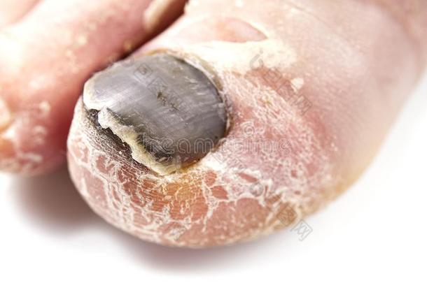 脚趾甲真菌隔离的向白色的.疼痛的脚趾甲,钉子真菌closure关闭