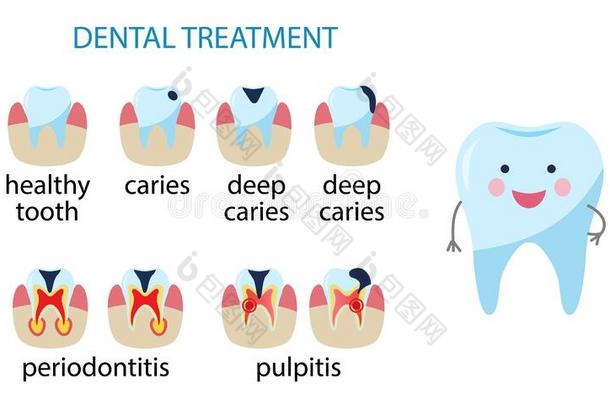 疾病关于牙.龋齿,牙髓炎,牙周炎.矢量图解