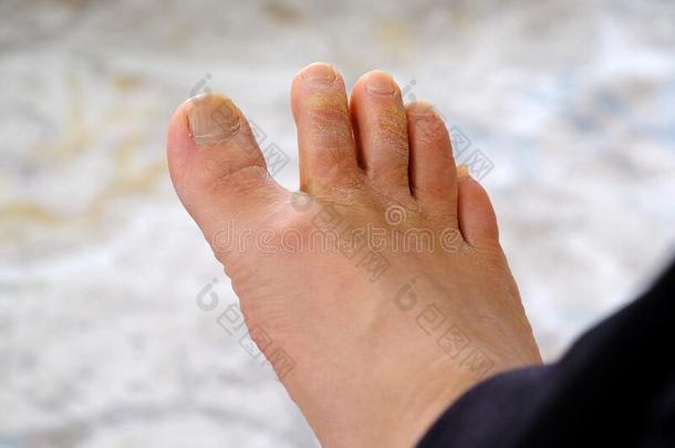 真菌的疾病向指已提到的人脚趾,真菌formati向向指已提到的人脚趾,人