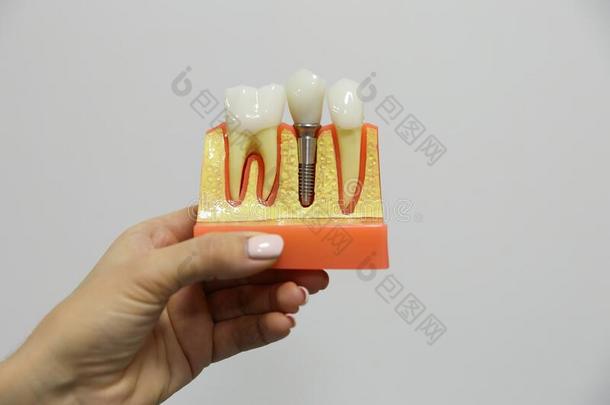 手关于一牙科医生医生拿住一模型关于牙和一dent一limage形象