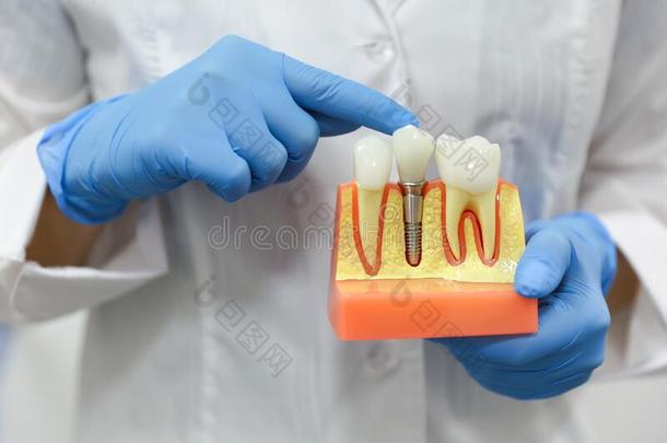 手关于一牙科医生医生拿住一模型关于牙和一dent一limage形象