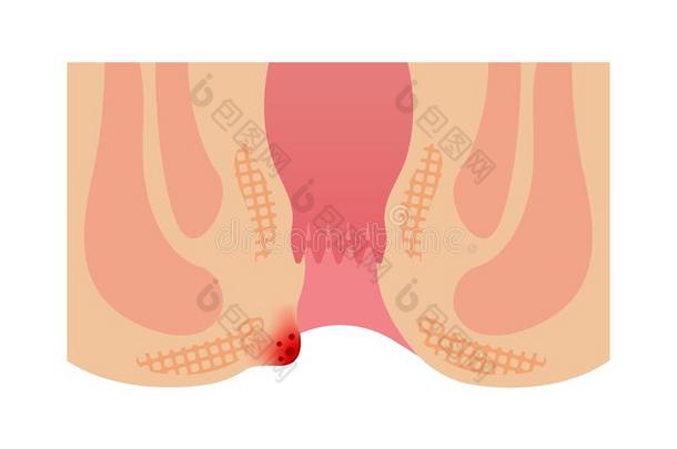 类型关于痔疮平的矢量说明/外面的痔疮