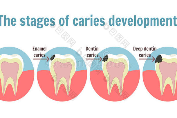 指已提到的人台关于龋齿发展.牙齿的牙痛象征