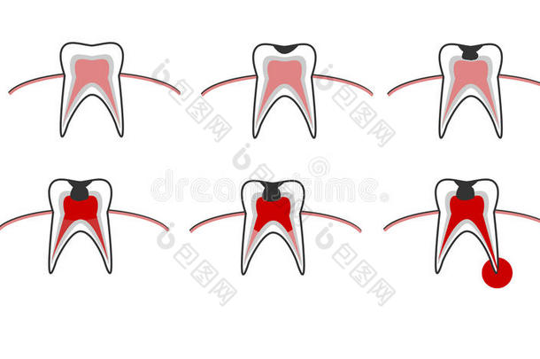 龋齿阶段,牙腐烂密谋和龋齿,口腔学的不好的