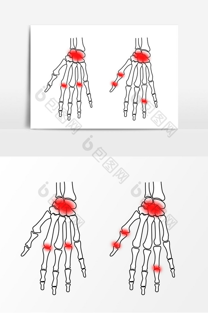 矢量手骨骨骼关节炎