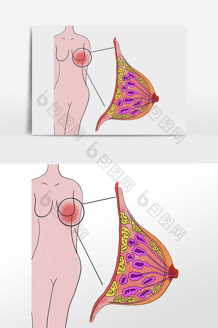 乳腺疾病乳腺增生