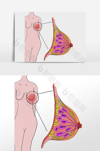 乳腺疾病乳腺增生图片