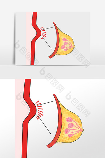 关爱乳房乳腺增生图片