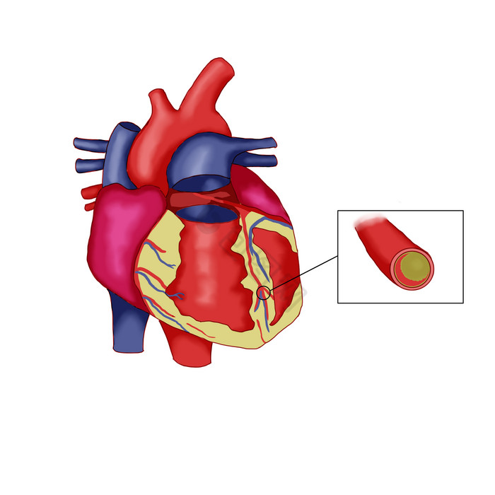 心血管冠心病血管疾病图片