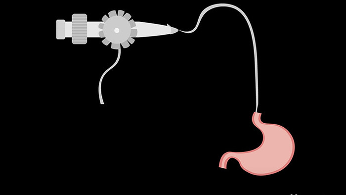 扁平风插画类医疗器材类胃镜MG动画