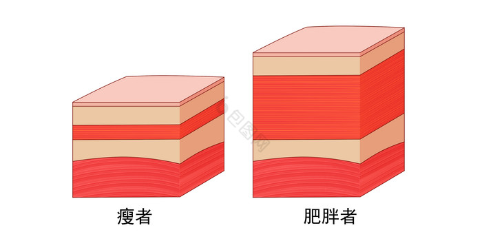 肥厚脂肪皮肤示意图图片