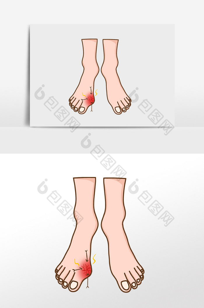 关节疼痛脚骨痛风