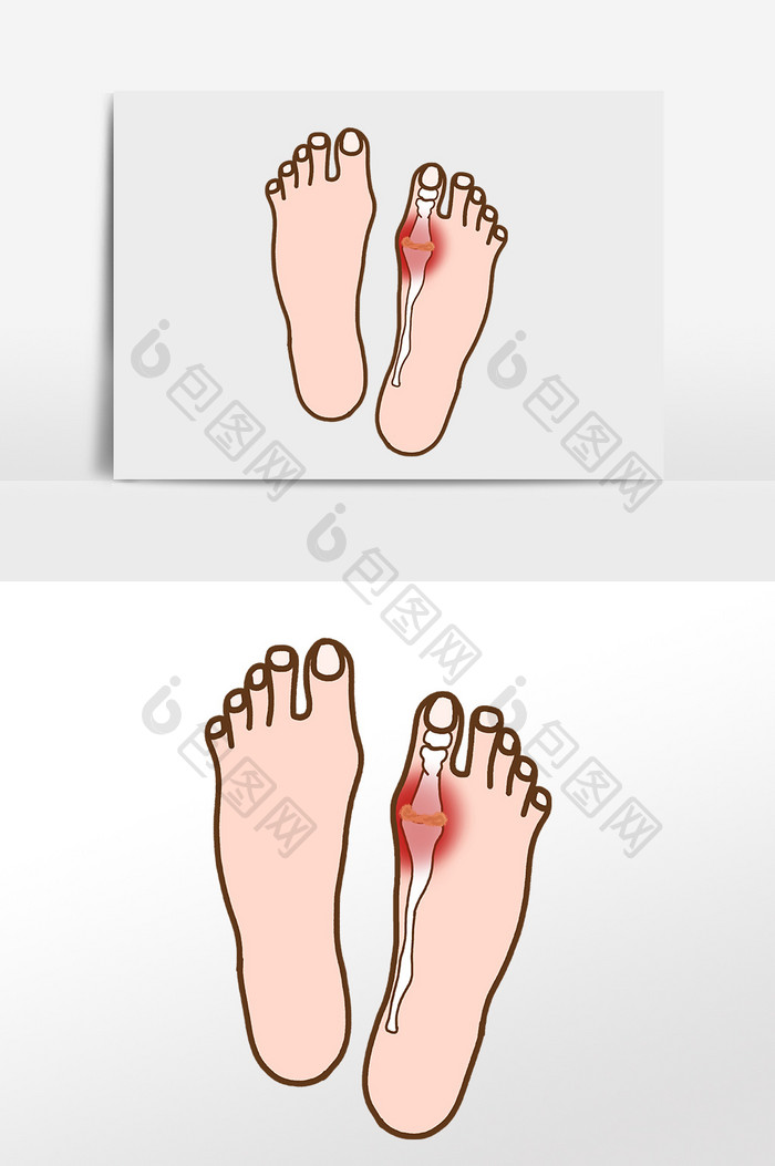 脚骨痛风关节疼痛