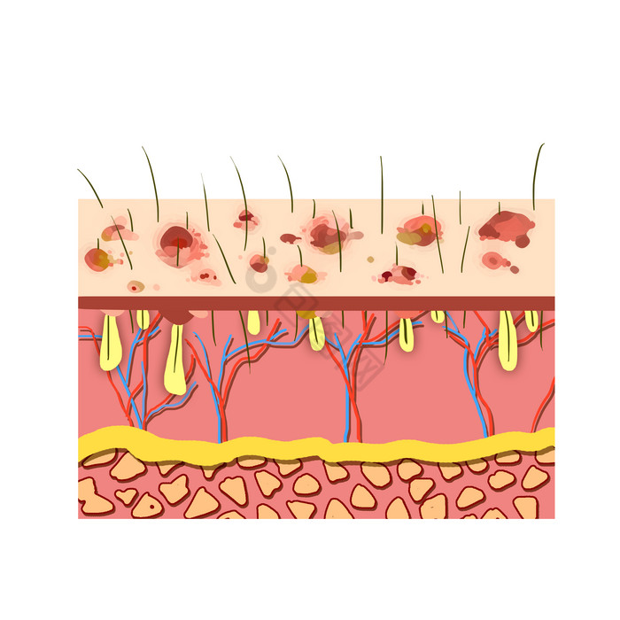 皮肤病疱疹炎症疾病图片