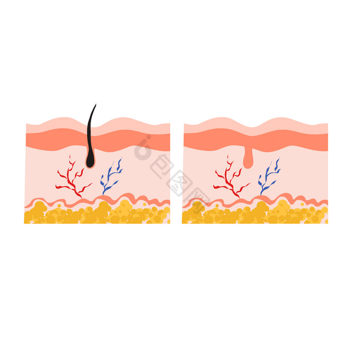 皮囊表皮毛发脱毛图片