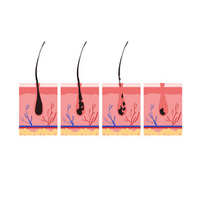 毛血管皮囊表皮毛发脱毛