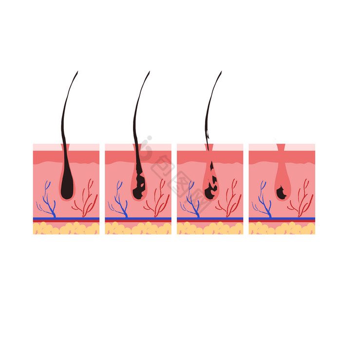 毛血管皮囊表皮毛发脱毛图片