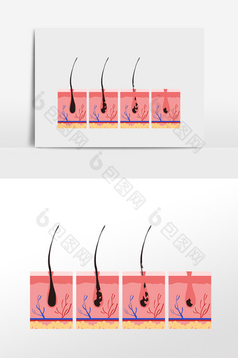 毛血管皮囊表皮毛发脱毛图片