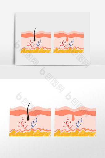毛血管表皮毛发脱毛图片