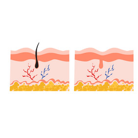 毛血管表皮毛发脱毛