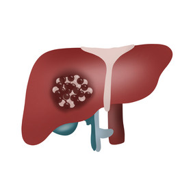 肝癌癌症肝硬化肝癌