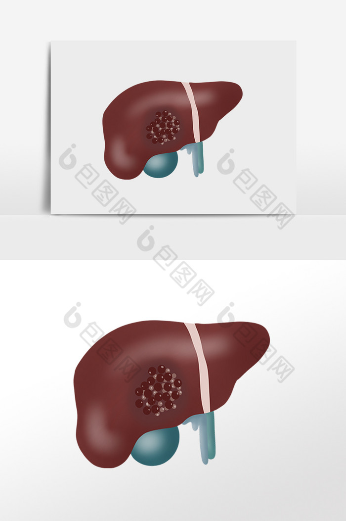 肝癌癌症肝脏肝炎图片图片