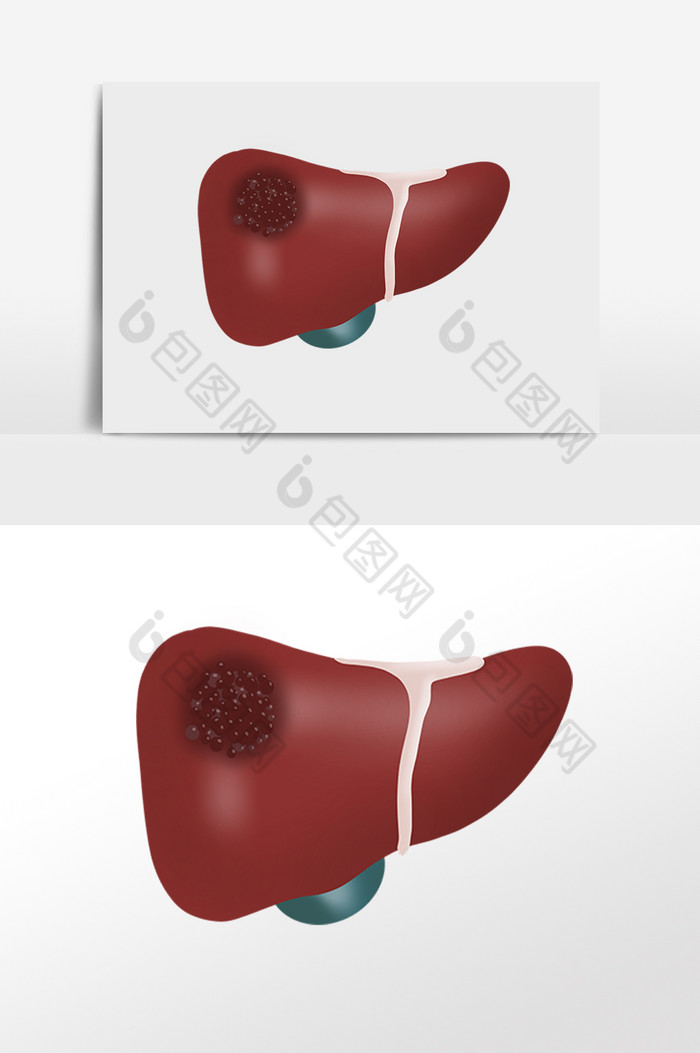 肝癌癌症肝脏肝硬化图片图片
