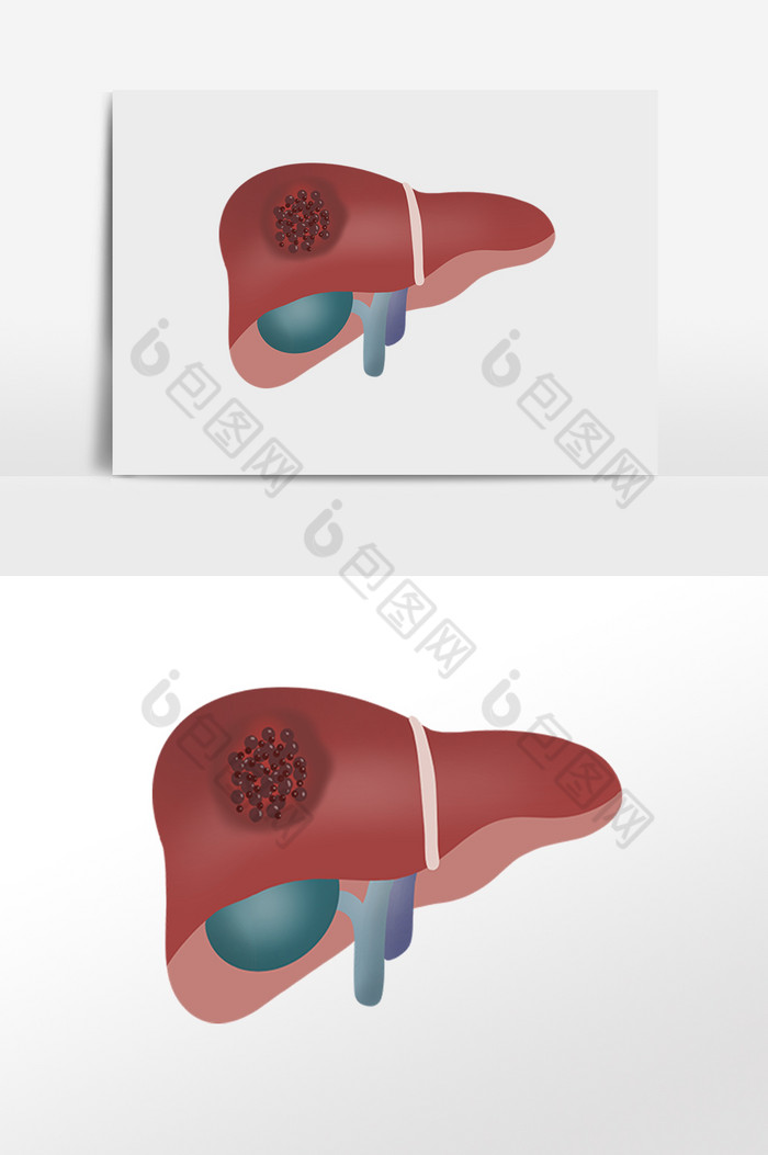 肝癌癌症肝炎肝脏图片图片