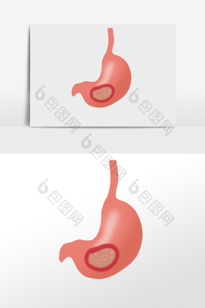 肠胃健康胃癌癌症图片图片
