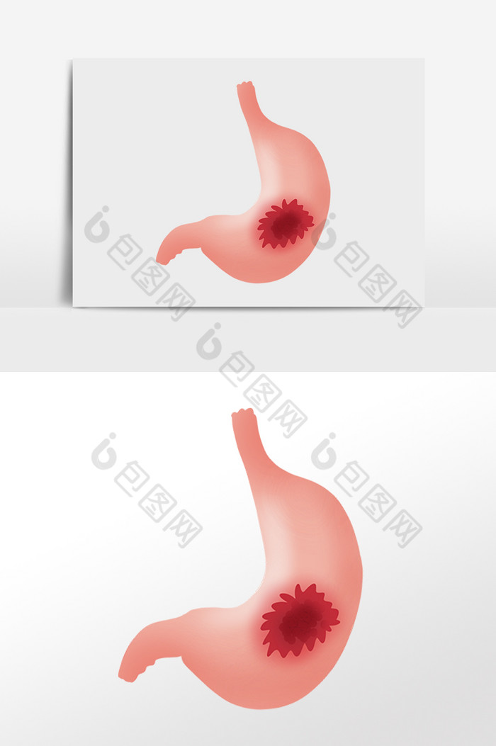 内脏胃癌胃炎癌症图片图片
