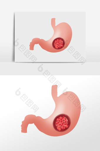 胃癌胃炎肠胃癌症图片