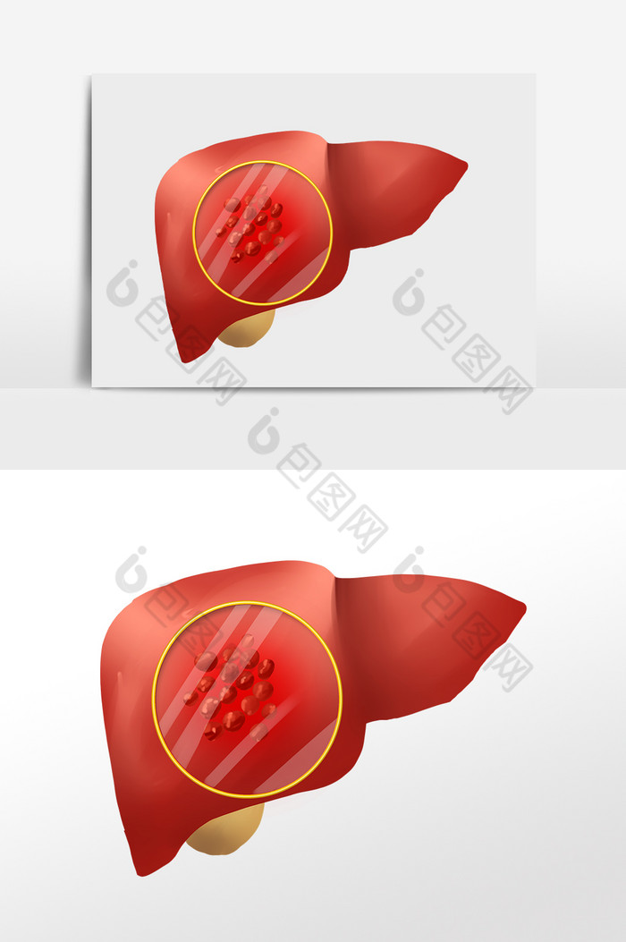肝炎肝癌癌症肝脏图片图片