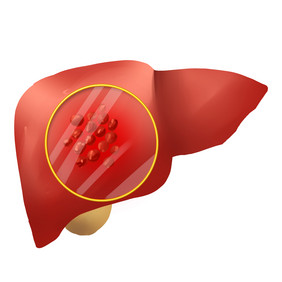 肝炎肝癌癌症肝脏