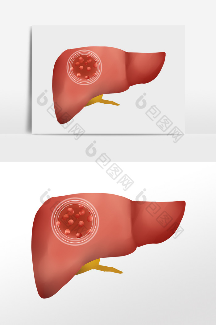肝硬化肝癌癌症肝脏图片图片