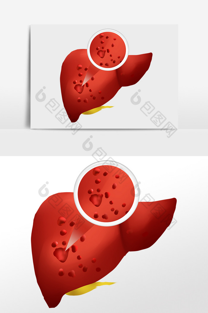 肝癌癌症肝硬化肝脏图片图片