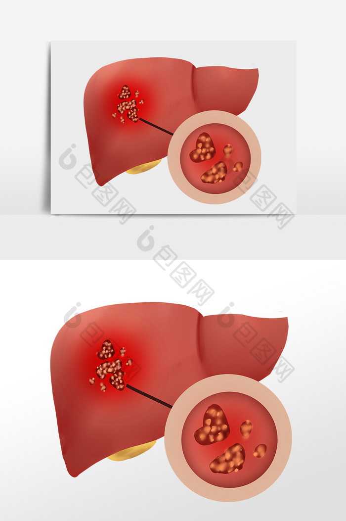 肝硬化肝癌癌症肝炎图片图片