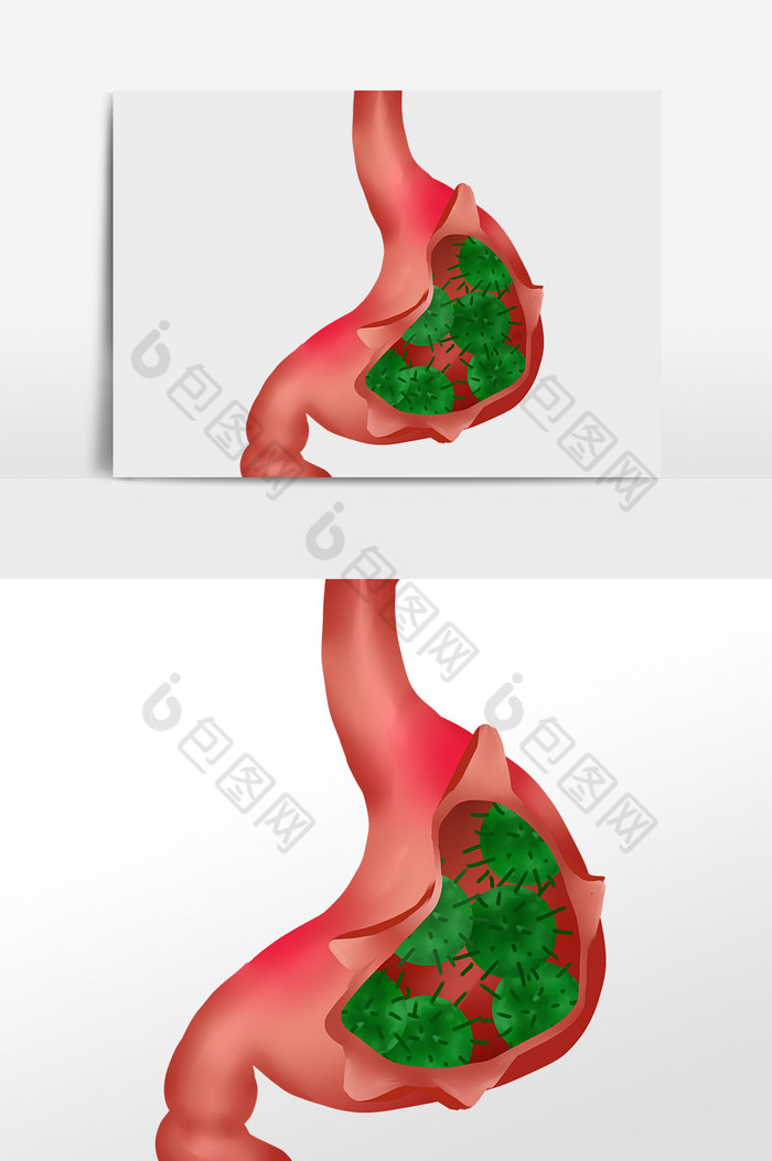 人体肠胃胃癌癌症图片图片