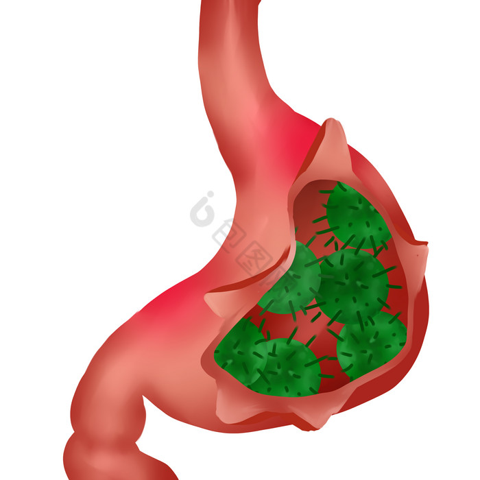 人体肠胃胃癌癌症图片
