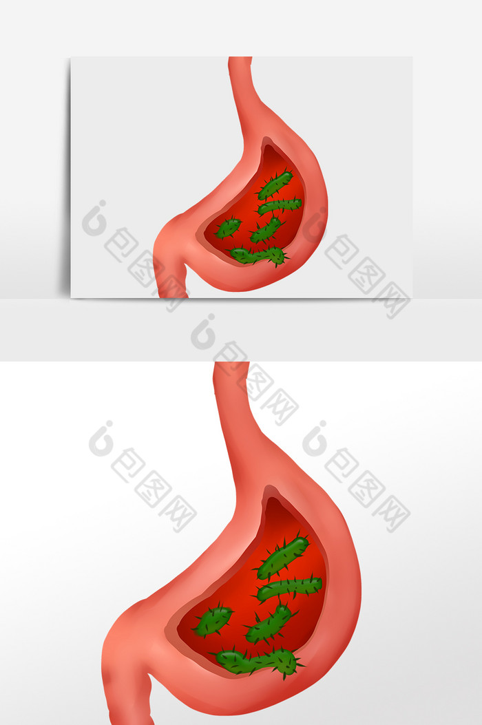 胃癌癌症胃炎肠胃图片图片