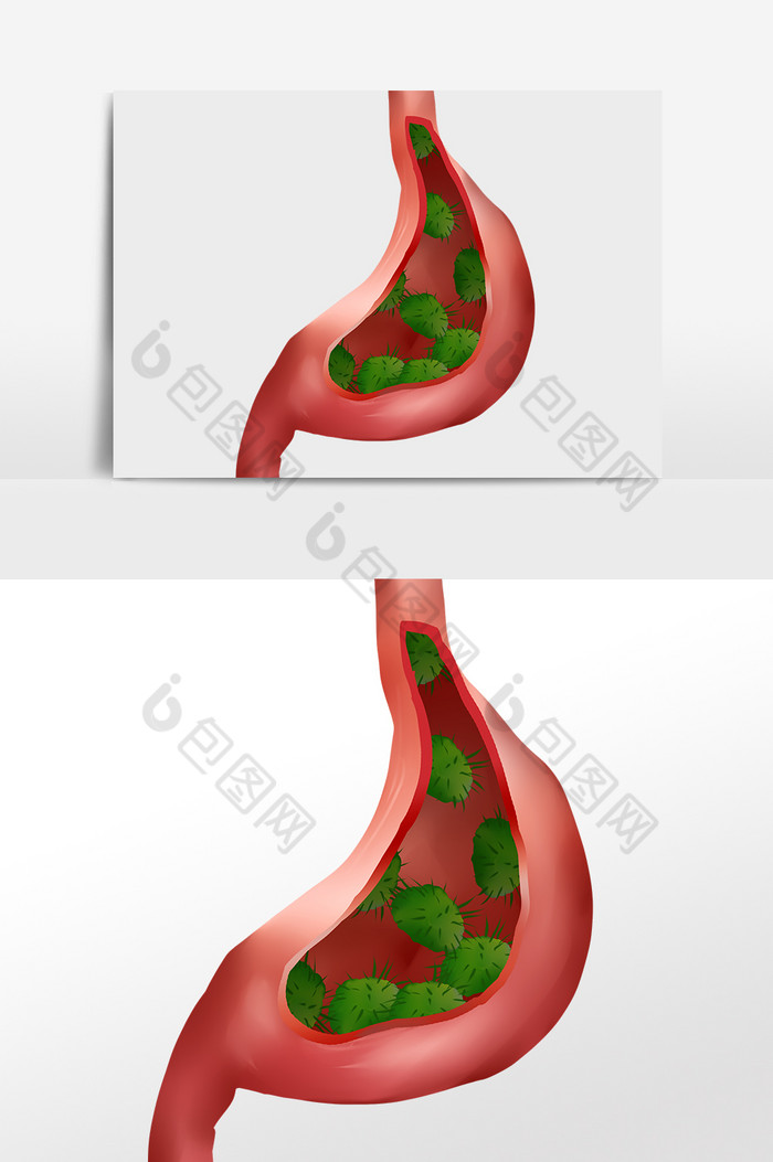 肠胃癌症胃癌胃炎图片图片