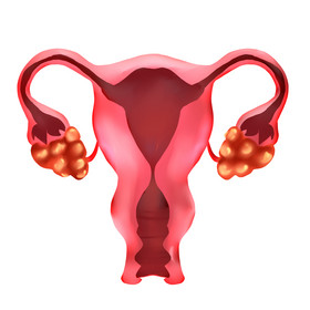 女性健康妇科病卵巢癌