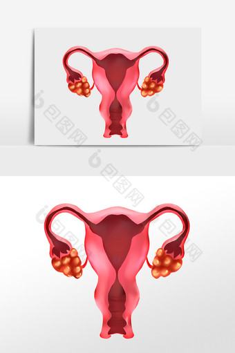 女性健康妇科病卵巢癌图片