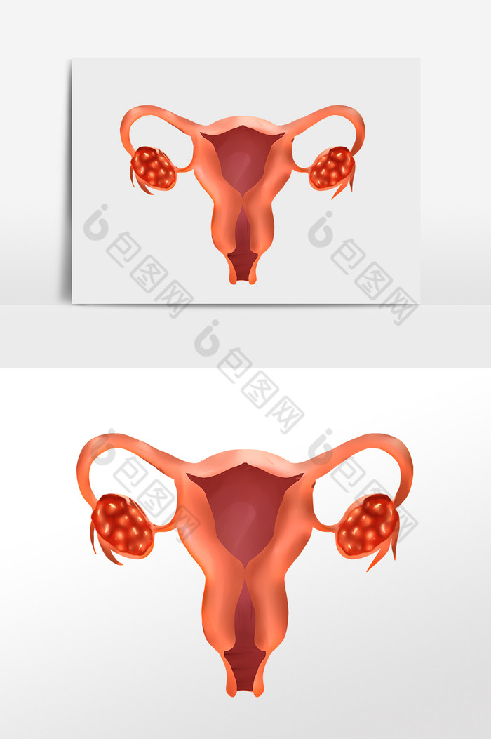 女性生殖器卵巢癌图片图片