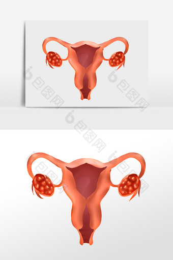 女性生殖器卵巢癌图片