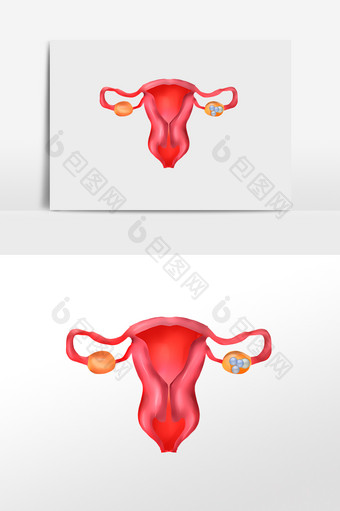 女性生殖器卵巢癌癌症图片